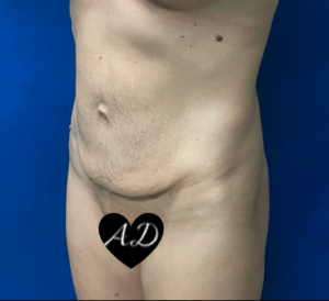 Abdominoplasty